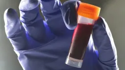 Blood Type B Linked to 28% Higher Type 2 Diabetes Risk