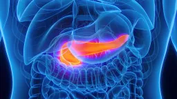 New AI Model Detects Pancreatic Cancer Years Before Diagnosis