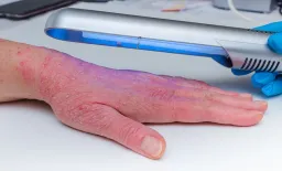 Phototherapy Safe and Effective for Elderly Psoriasis Patients, Study Finds