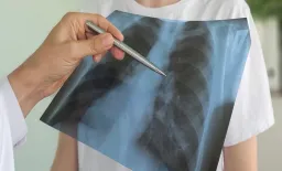 New Guidelines Overhaul Pulmonary Embolism Care
