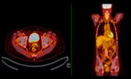 England Faces PET-CT Scan Shortage Amid Rising Demand