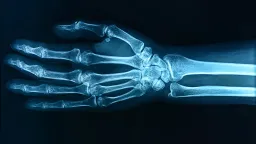 'Forever Chemicals' Linked to Weakened Bones in Children, New Study Warns