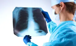 AI Model Revolutionizes Pulmonary Nodule Diagnosis Accuracy