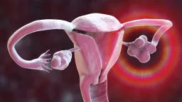 PCOS Renamed to PMOS After Century of Misleading Terminology
