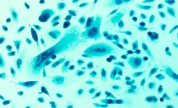 PRECISE MRI Score Refines Prostate Cancer Monitoring