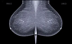 AI Mammography Results Undermine Patient Trust Without Context