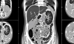 Elderly CT Scans Surge, Prompting Radiation Exposure Concerns