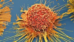 Molecular Jackhammers: A New Mechanical Attack on Cancer Cells