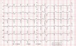 Septal Imaging Marker Flags Severe Heart Block in Myocarditis