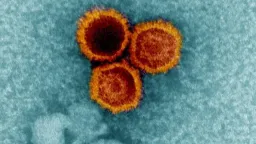 Common Virus Epstein-Barr Linked to Multiple Sclerosis Onset