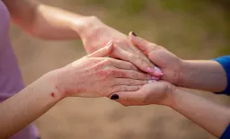 Extended Steroid Treatment in Atopic Dermatitis Tied to More Health Complications