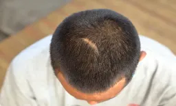 Silicone Gel: A Breakthrough for Head and Neck Scar Improvement