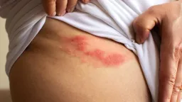 Shingles: A Painful Reality Beyond the Rash