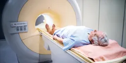 Microplastics Found in Prostate Cancer Tumors: NYU Study Raises Health Concerns