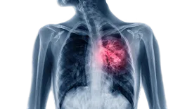 SPECT Scans Offer Low-Risk Alternative for Pulmonary Embolism Diagnosis