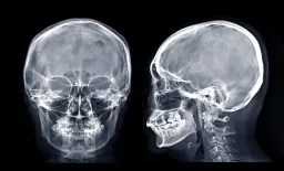 AI-Generated X-Rays Challenge Radiologist Accuracy