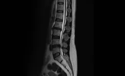 Targeted Therapy Restores Independence in Rare Spinal Vascular Lesion Patients