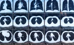 Saline Tract Sealing Cuts Pneumothorax Risk After Lung Biopsy