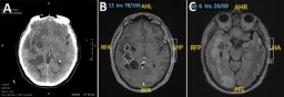 Doctors Suspect Brain Cancer But Find Parasitic Worms Instead