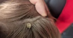 Merritt Father Warns of Tick Paralysis After Son’s Medical Emergency