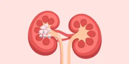 Primary Hyperoxaluria: New Treatment Options Emerge