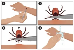 Ticks Are Worse Than Ever This Year: Stay Safe Now