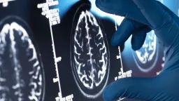 Viagra and Shingles Vaccine Show Alzheimer's Prevention Promise