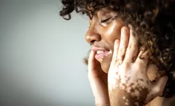 Vitiligo's Social Burden Extends Beyond Skin, New Review Reveals