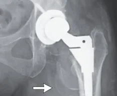Hip Replacement Causes Severe Cobalt Poisoning in Woman