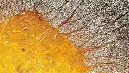 Foamy Microglia Linked to Severe Multiple Sclerosis Progression
