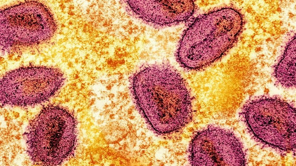 Singapore Reports First Local Mpox Cases Amid Clade Ib Outbreak