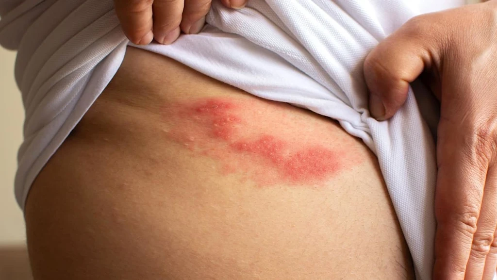 Shingles: A Painful Reality Beyond the Rash