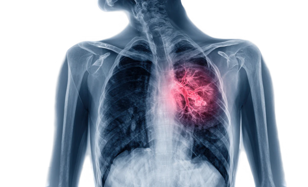 SPECT Scans Offer Low-Risk Alternative for Pulmonary Embolism Diagnosis