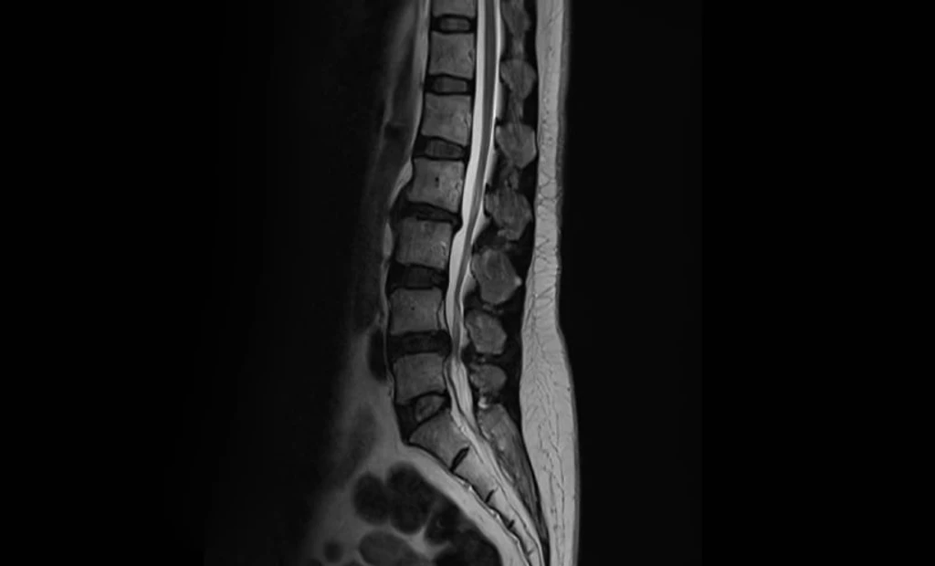 Targeted Therapy Restores Independence in Rare Spinal Vascular Lesion Patients