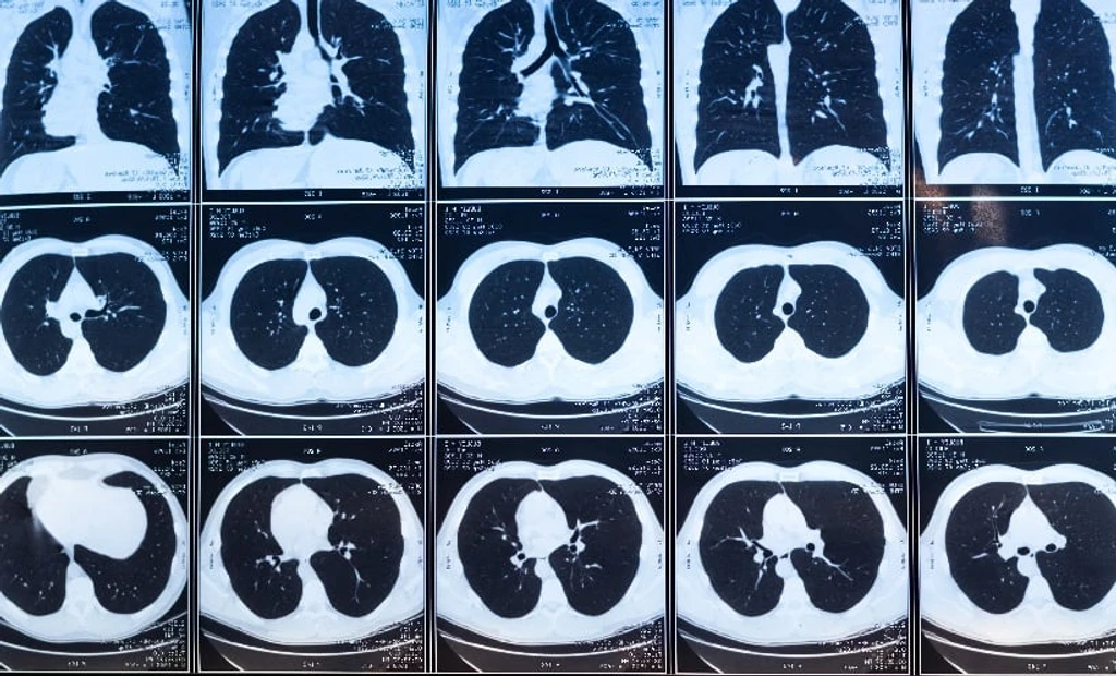 Saline Tract Sealing Cuts Pneumothorax Risk After Lung Biopsy