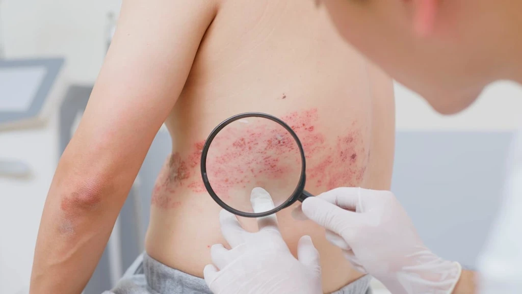 Shingles Vaccine Linked to Fewer Heart Attacks and Strokes, Study Suggests