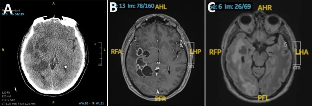 Doctors Suspect Brain Cancer But Find Parasitic Worms Instead