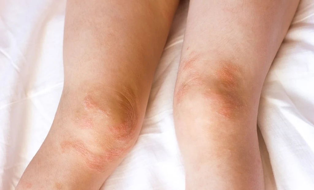 Upadacitinib Maintains Safety Across Age Groups in Atopic Dermatitis