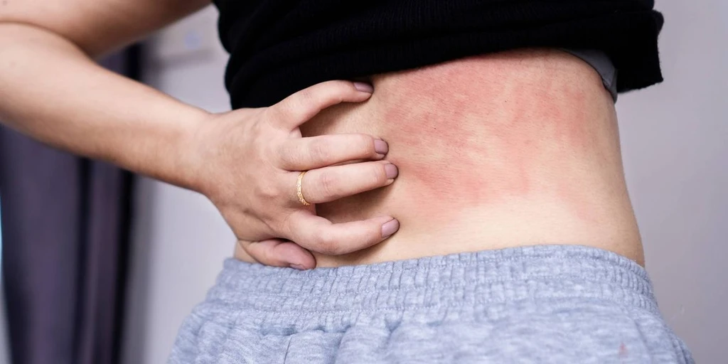 Beyond the Skin: The Hidden Toll of Chronic Spontaneous Urticaria