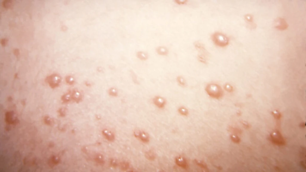 Rare Chickenpox Complication Leads to Extreme Scar Tissue Growth