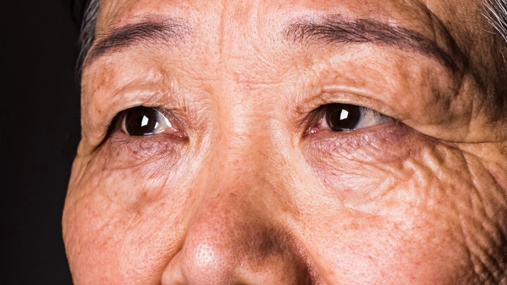 Vision Decline May Signal Dementia Risk 12 Years Early