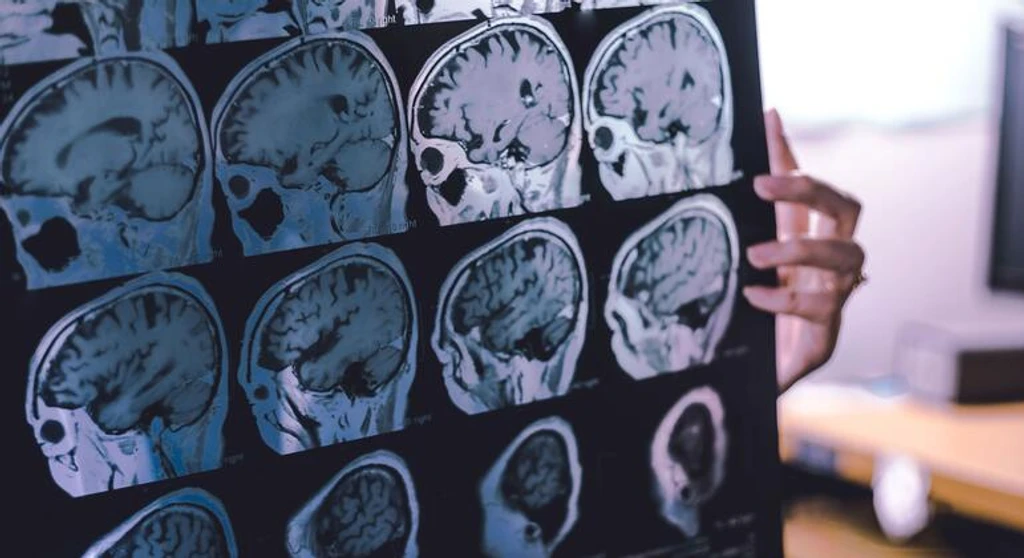 WHO: Up to 45% of Dementia Cases Are Preventable