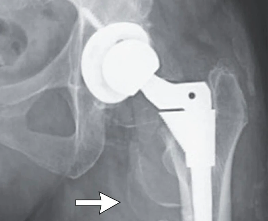 Hip Replacement Causes Severe Cobalt Poisoning in Woman