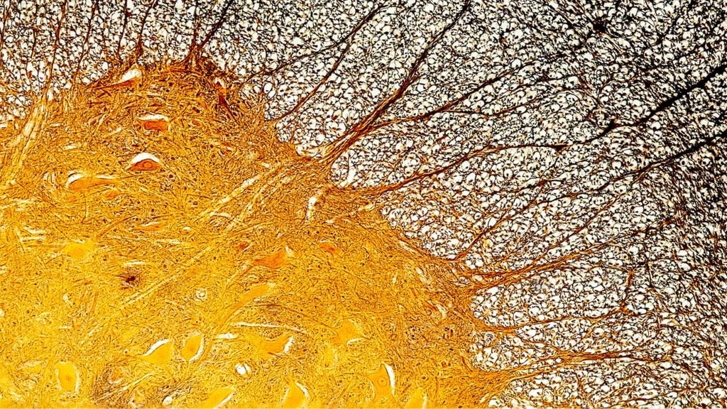 Foamy Microglia Linked to Severe Multiple Sclerosis Progression
